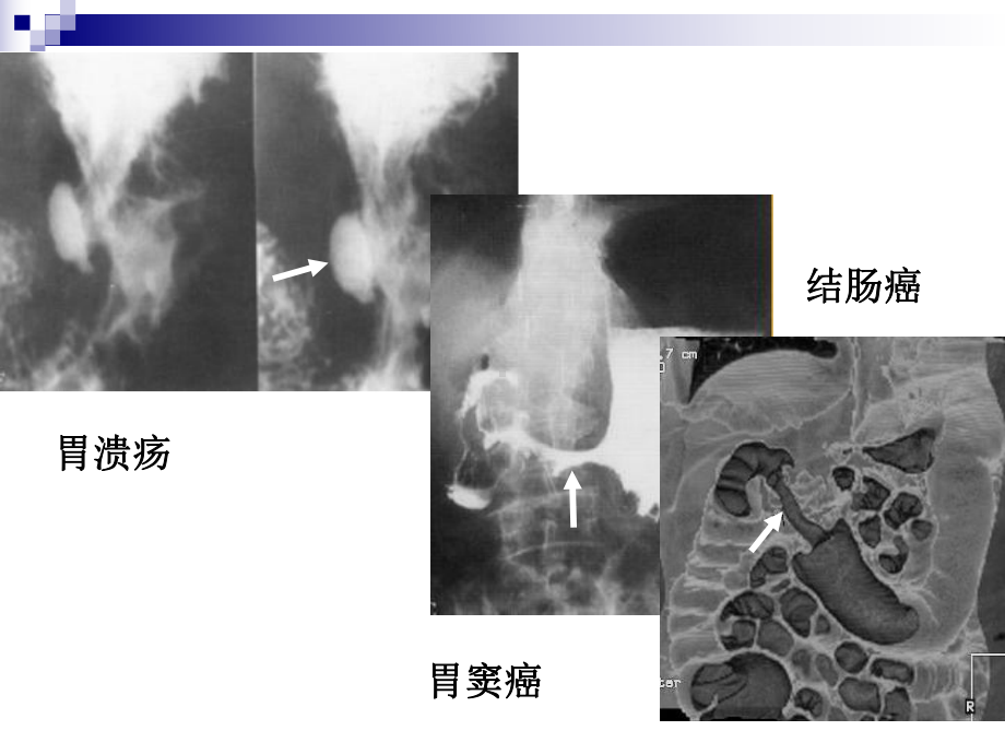 医学胃肠道正常影像表现基本病变培训课件.ppt_第3页