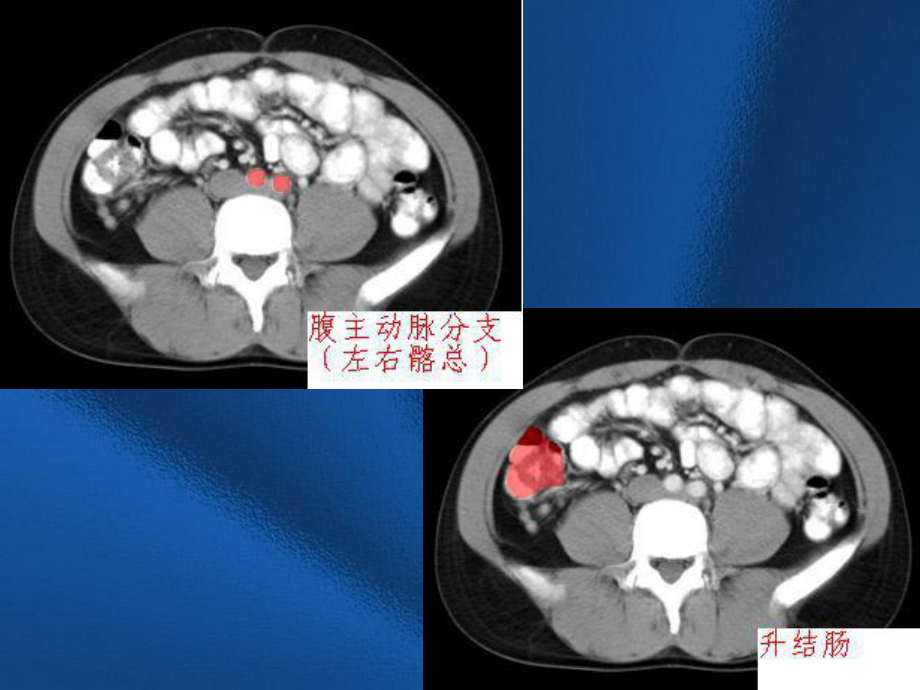 医学课件-盆腔内常见疾病CT诊断课件.ppt_第3页