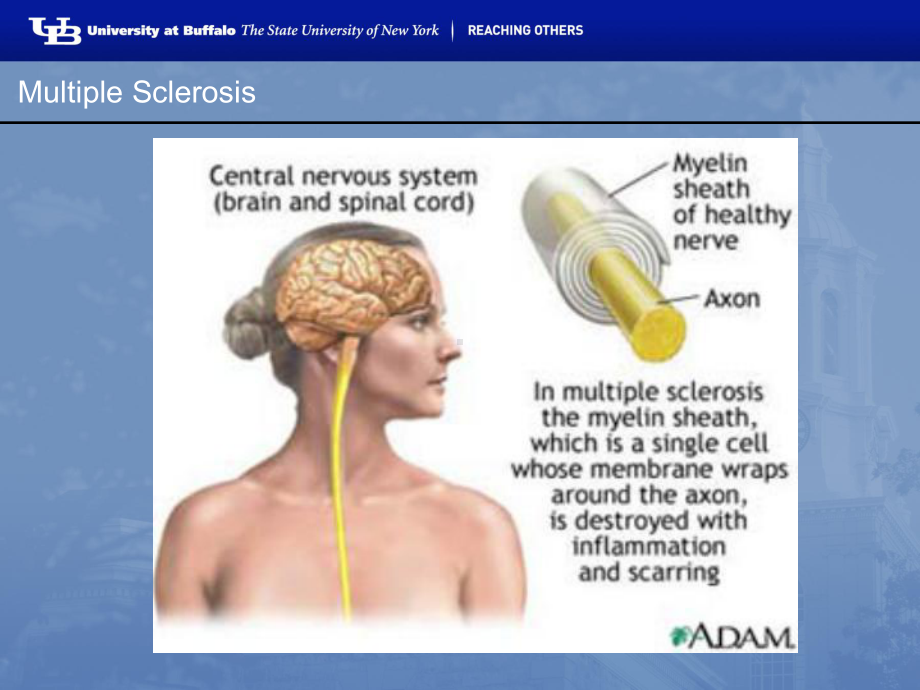多发性硬化英文-课件.pptx_第3页