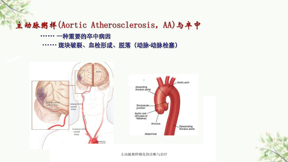 主动脉粥样硬化的诊断与治疗课件.ppt_第3页