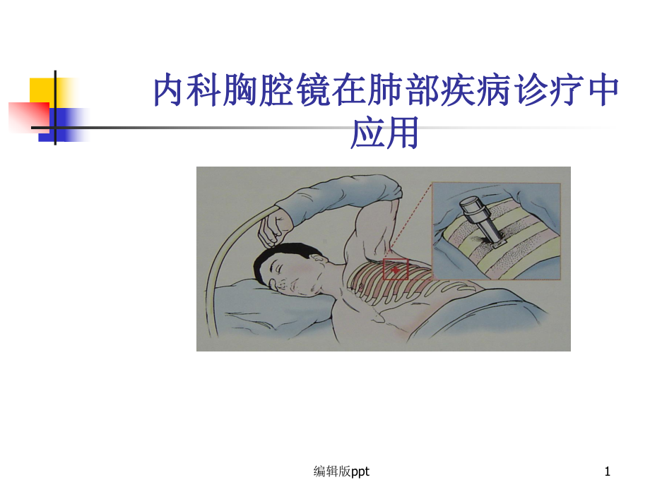 内科胸腔镜在肺部诊疗中的作用课件.ppt_第1页