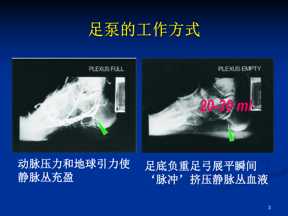 国外动静脉泵在治疗周围血管疾病的应用课件.ppt_第3页