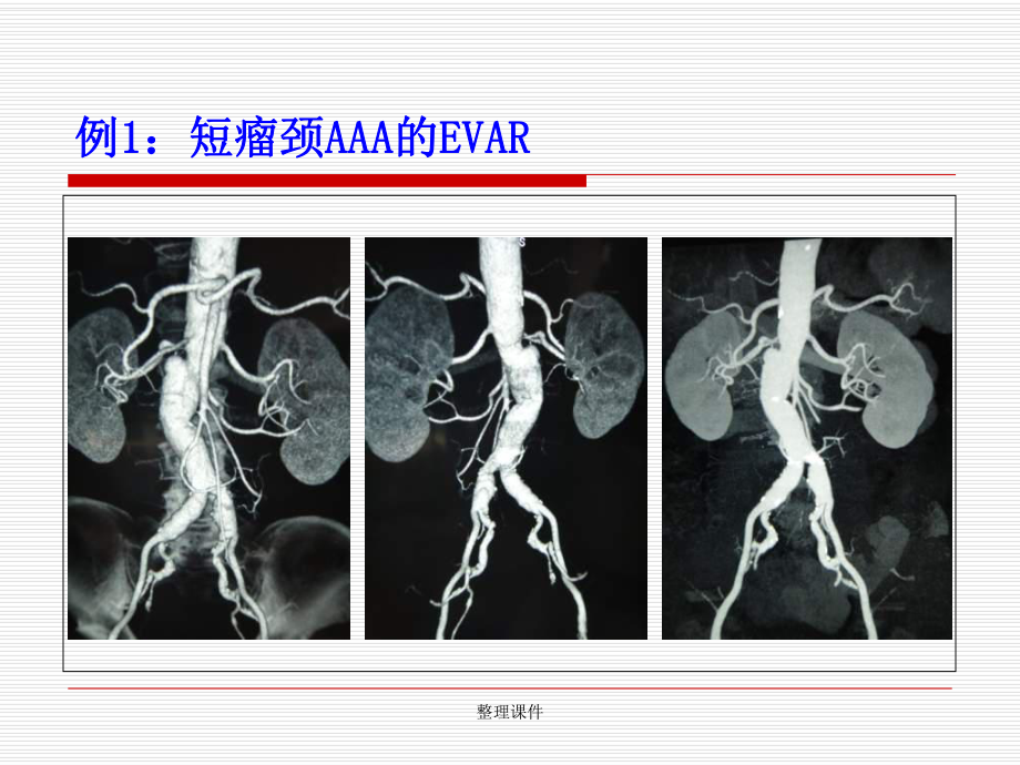 复杂腹主动脉瘤的腔内治疗课件.ppt_第3页