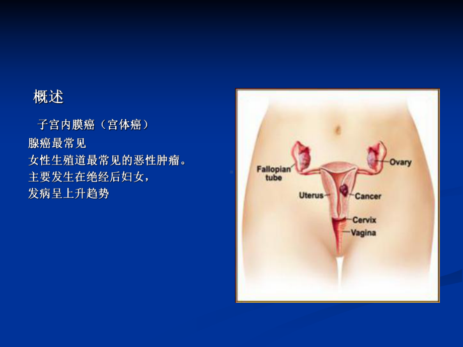 子宫内膜癌医学课件.ppt_第2页