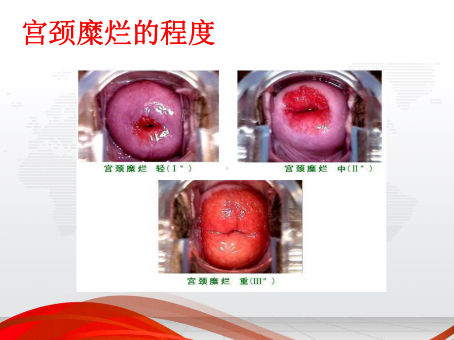 女性健康知识讲座(宫颈疾病)课件.ppt_第3页