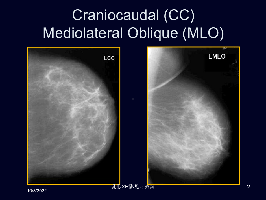 乳腺XR影见习教案课件.ppt_第2页