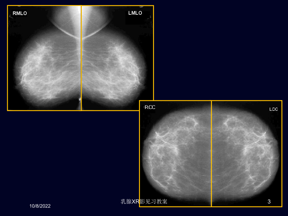 乳腺XR影见习教案课件.ppt_第3页