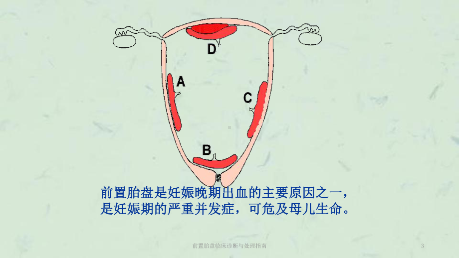 前置胎盘临床诊断与处理指南课件.ppt_第3页