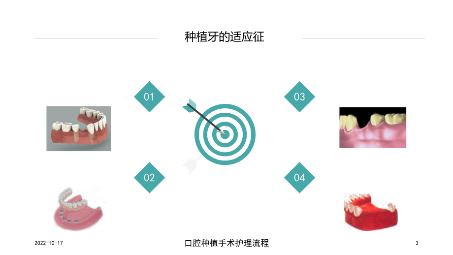 口腔种植手术护理流程培训课件.ppt_第3页