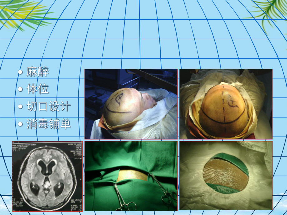 内镜第三脑室造口术治疗脑积水课件.ppt_第3页