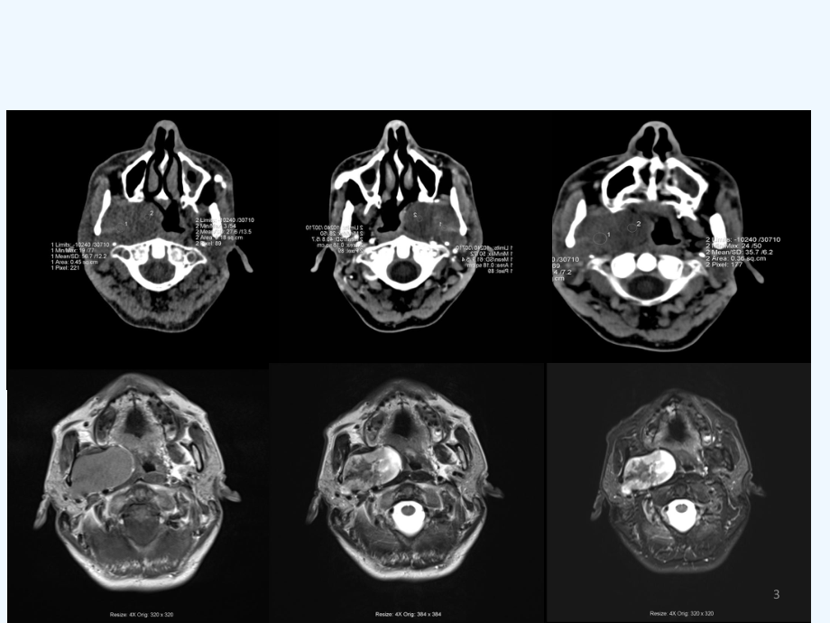咽旁间隙病变影像诊断与鉴别省医放射科课件.ppt_第3页