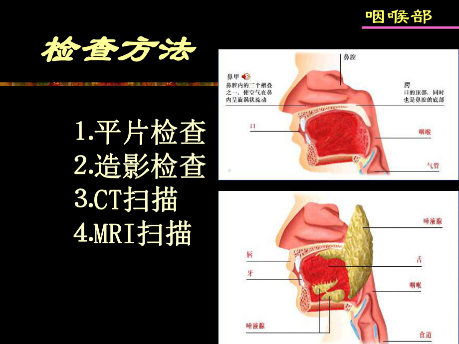 咽喉疾病影像诊断课件.pptx_第3页