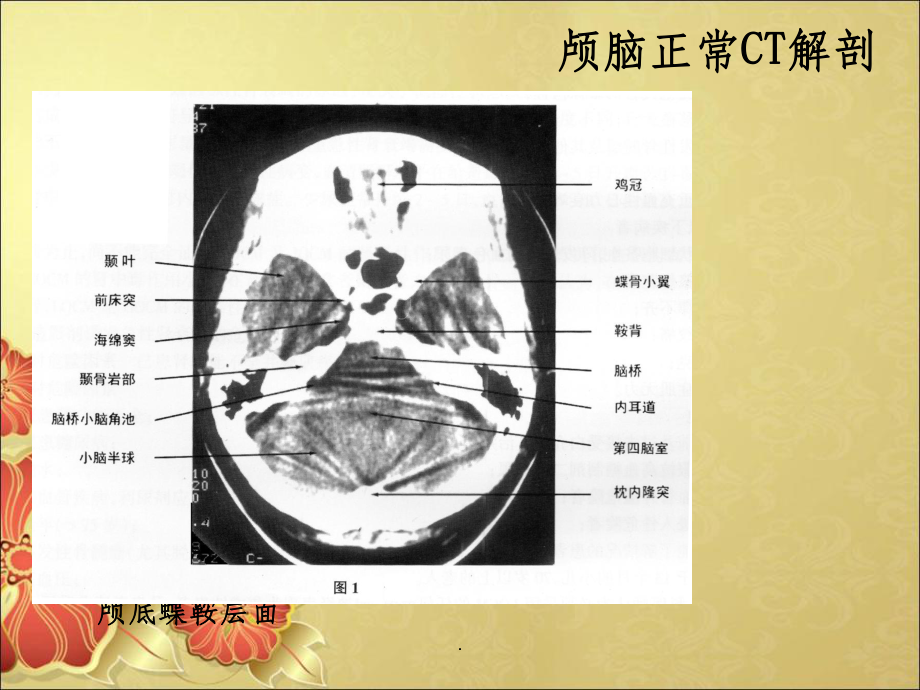 头部CT解剖及诊断基础课件.ppt_第3页