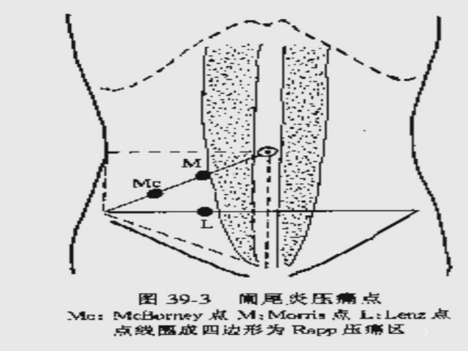 外科阑尾疾病的诊断和治疗教学课件.ppt_第3页