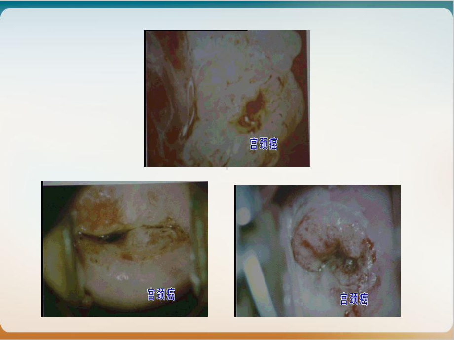 妇科疾病图片课件.pptx_第3页