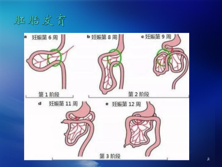 医学课件-肠旋转不良课件.pptx_第2页