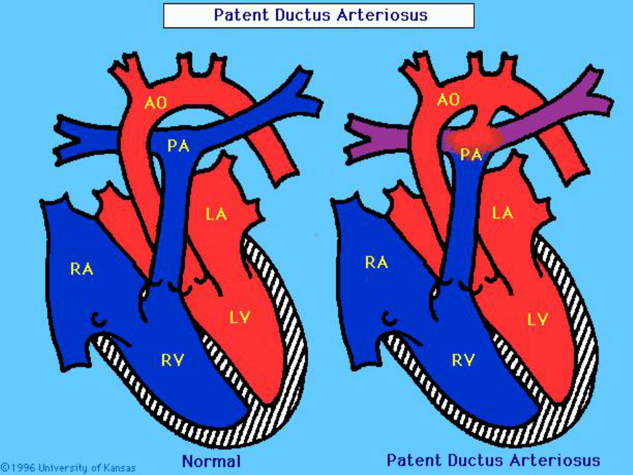 动脉导管未闭PDA课件.ppt_第2页