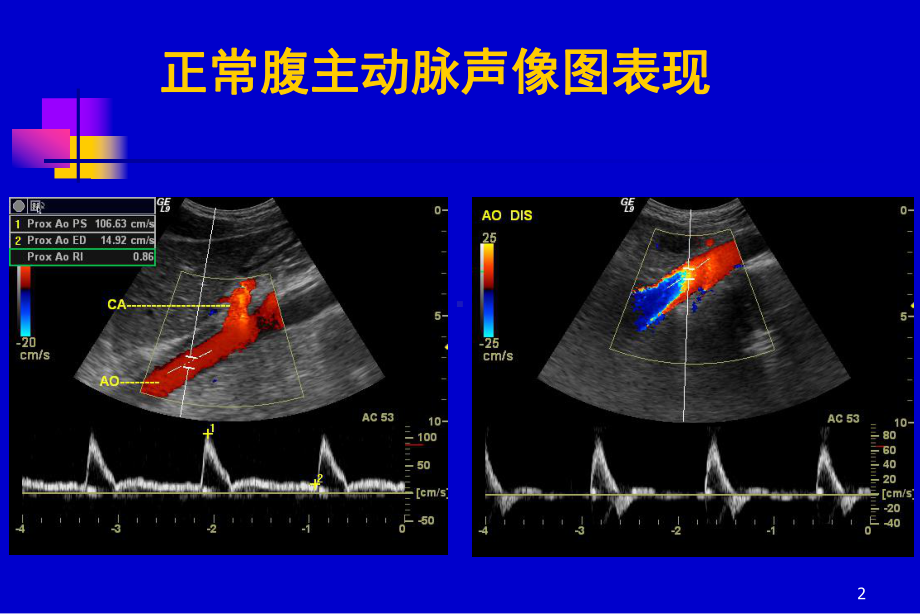 医学课件腹膜后大血管超声.ppt_第2页