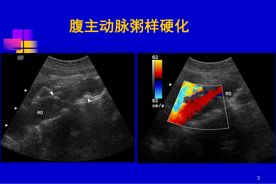 医学课件腹膜后大血管超声.ppt_第3页