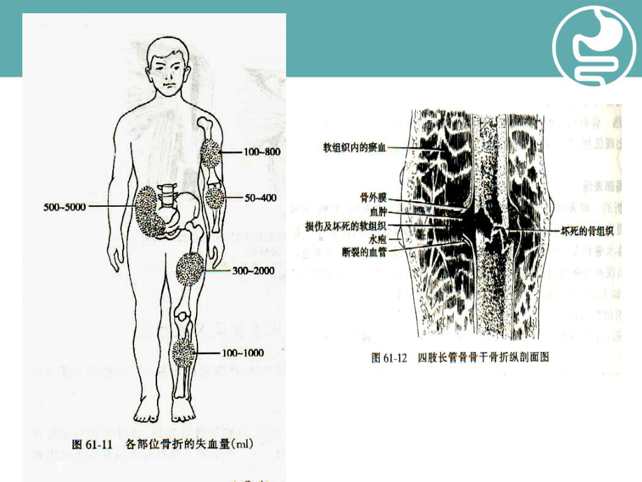 四肢骨折经典学习课件.ppt_第3页