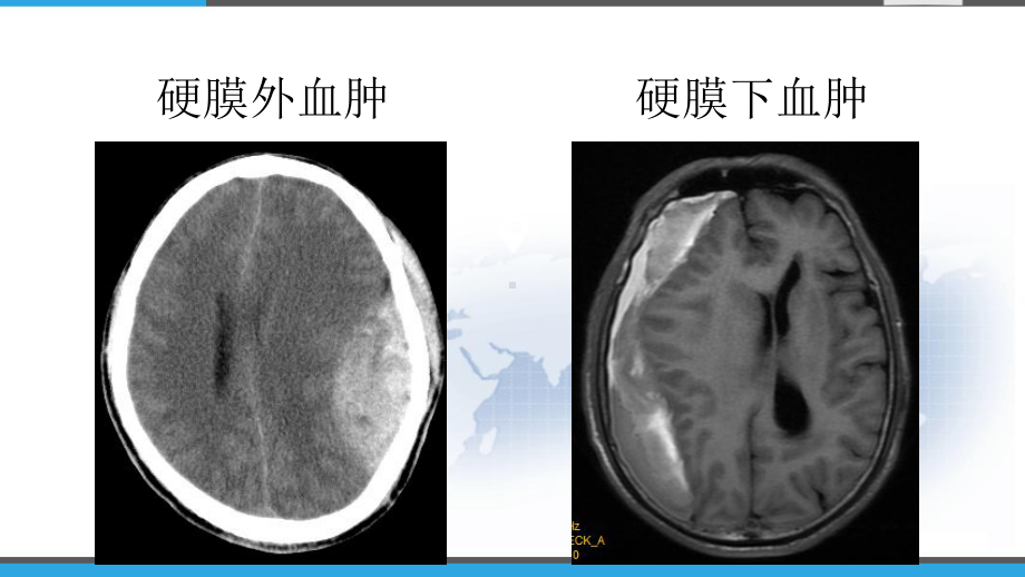 基层神经外科常见引流管介绍-课件.pptx_第3页