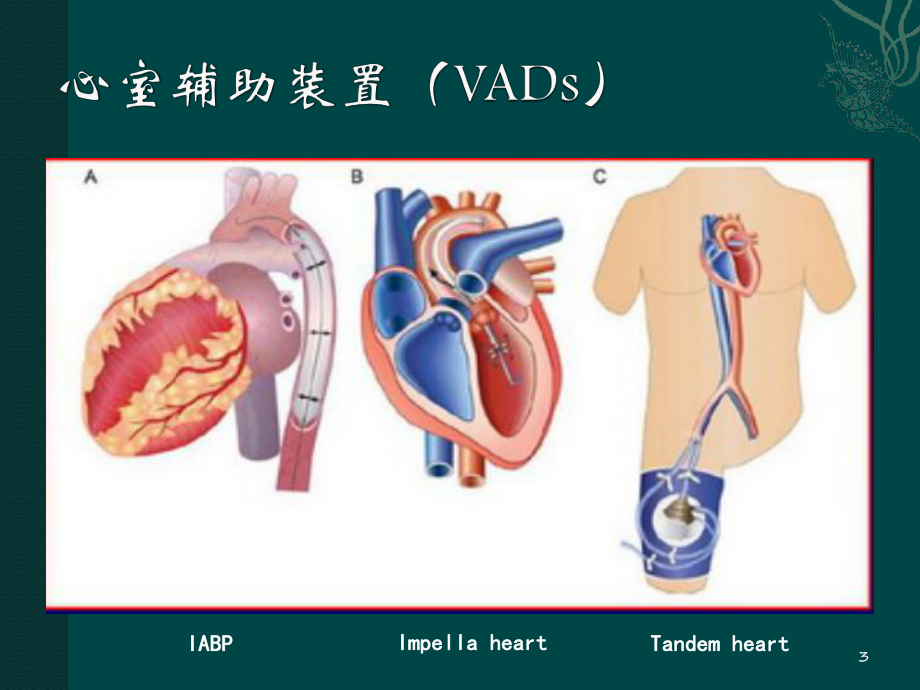 主动脉球囊反搏术的应用医学课件.ppt_第3页