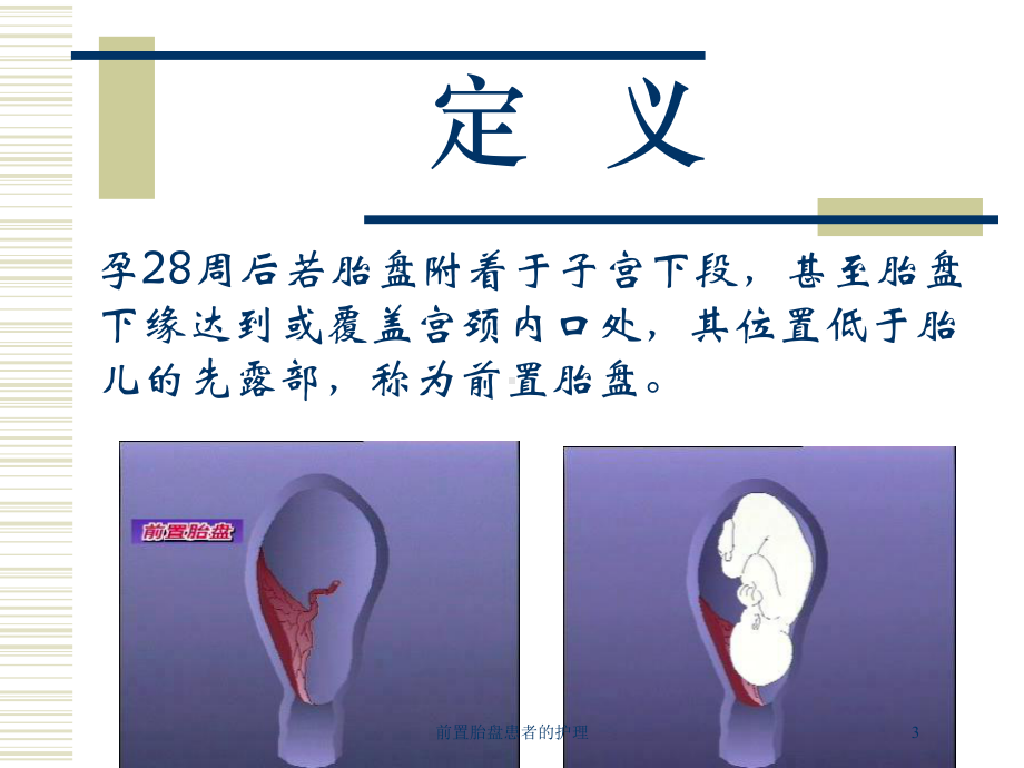 前置胎盘患者的护理培训课件.ppt_第3页