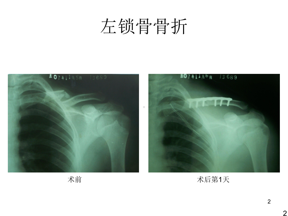 医学课件-骨折X线片汇总教学课件.ppt_第2页