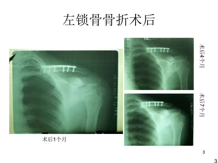 医学课件-骨折X线片汇总教学课件.ppt_第3页