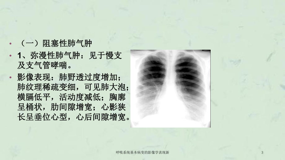 呼吸系统基本病变的影像学表现新课件.ppt_第3页