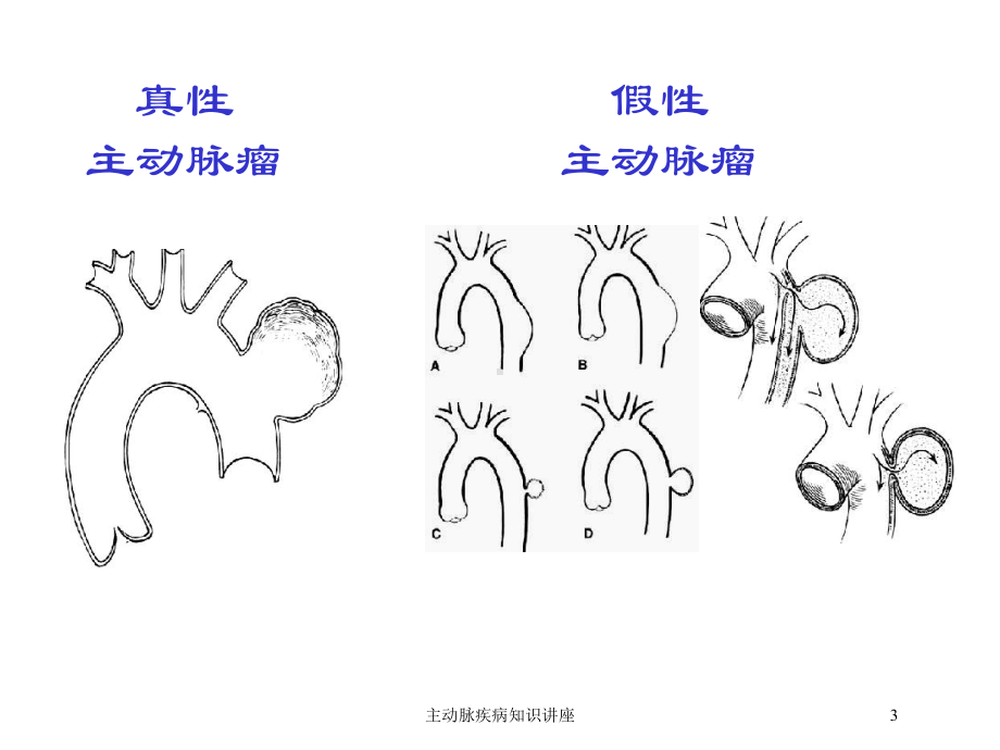 主动脉疾病知识讲座培训课件.ppt_第3页