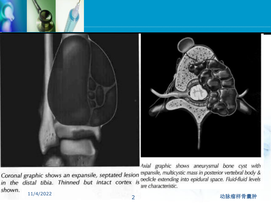 动脉瘤样骨囊肿培训课件.ppt_第2页