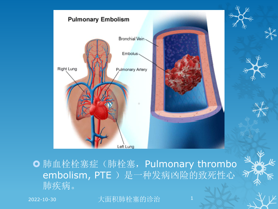 大面积肺栓塞的诊治培训课件.ppt_第1页