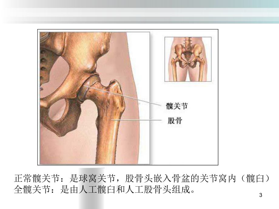 全髋关节置换术后护理课件(演示).ppt_第3页