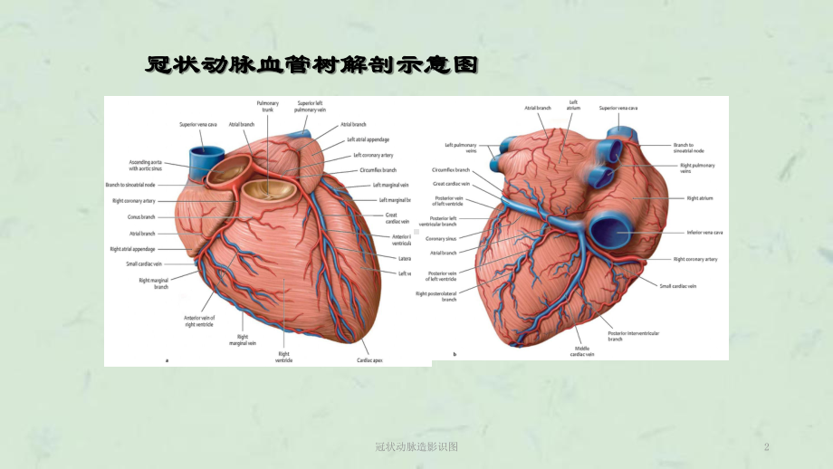 冠状动脉造影识图课件.ppt_第2页