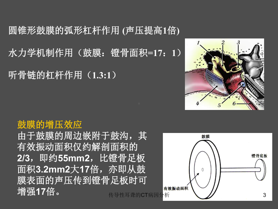 传导性耳聋的CT病因分析培训课件.ppt_第3页