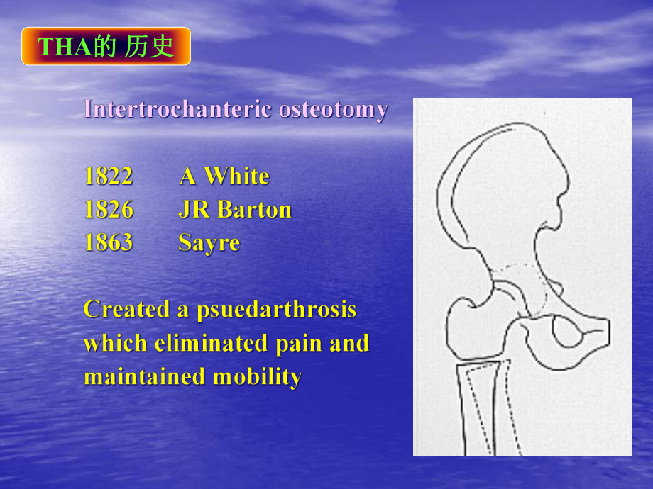 初次髋关节置换课件.ppt_第3页