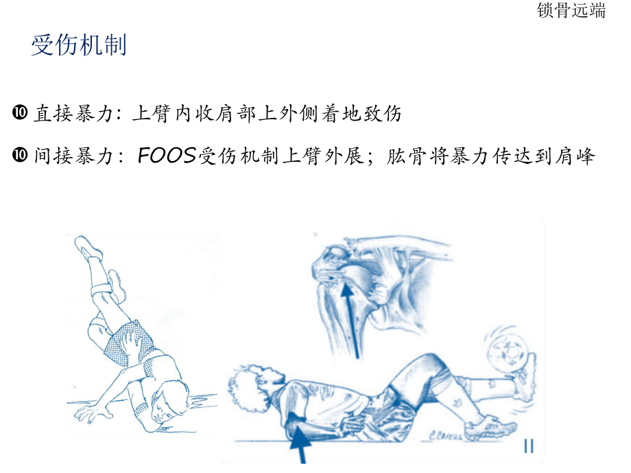 医学锁骨远端骨折培训课件.ppt_第3页