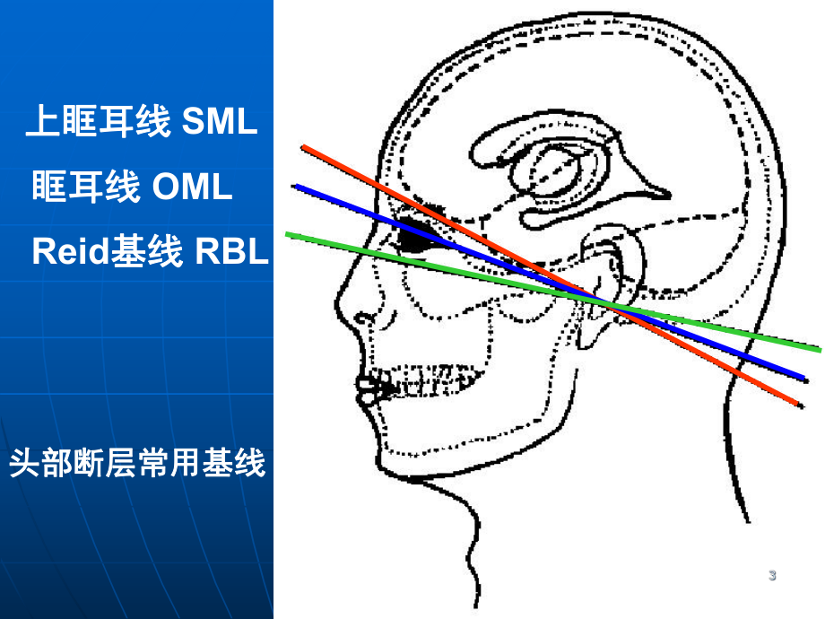 头颅CT解剖及诊断优质课件.ppt_第3页