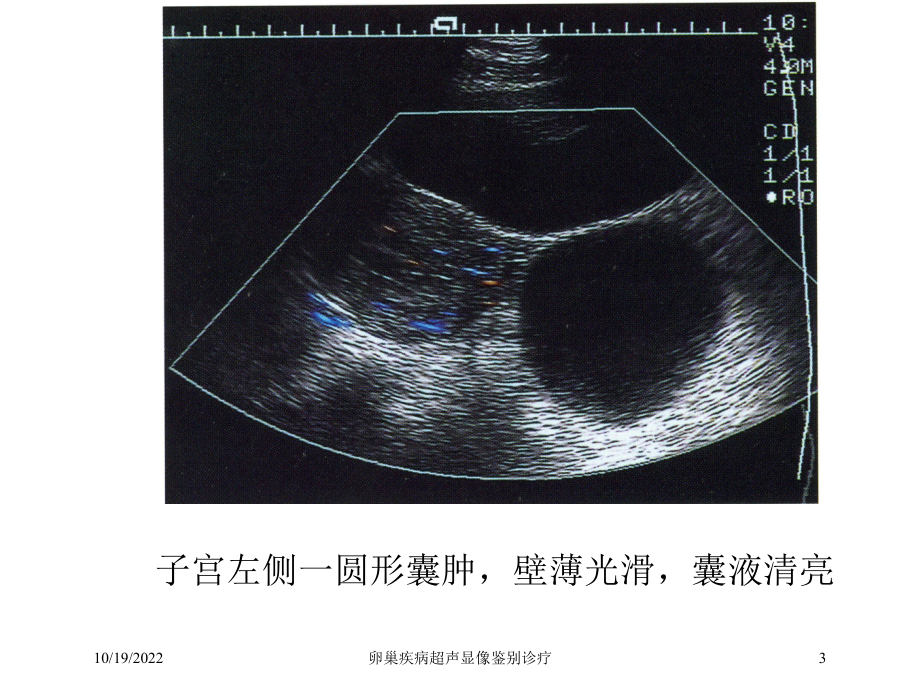 卵巢疾病超声显像鉴别诊疗课件.ppt_第3页