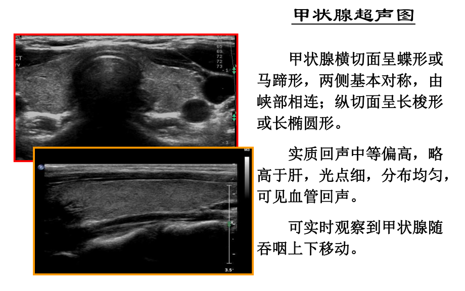 医学课件甲状腺的超声解读.ppt_第2页