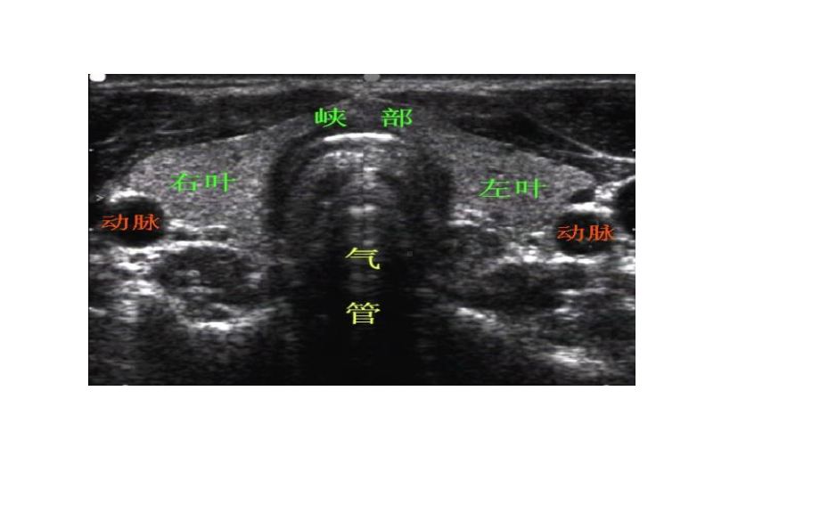 医学课件甲状腺的超声解读.ppt_第3页