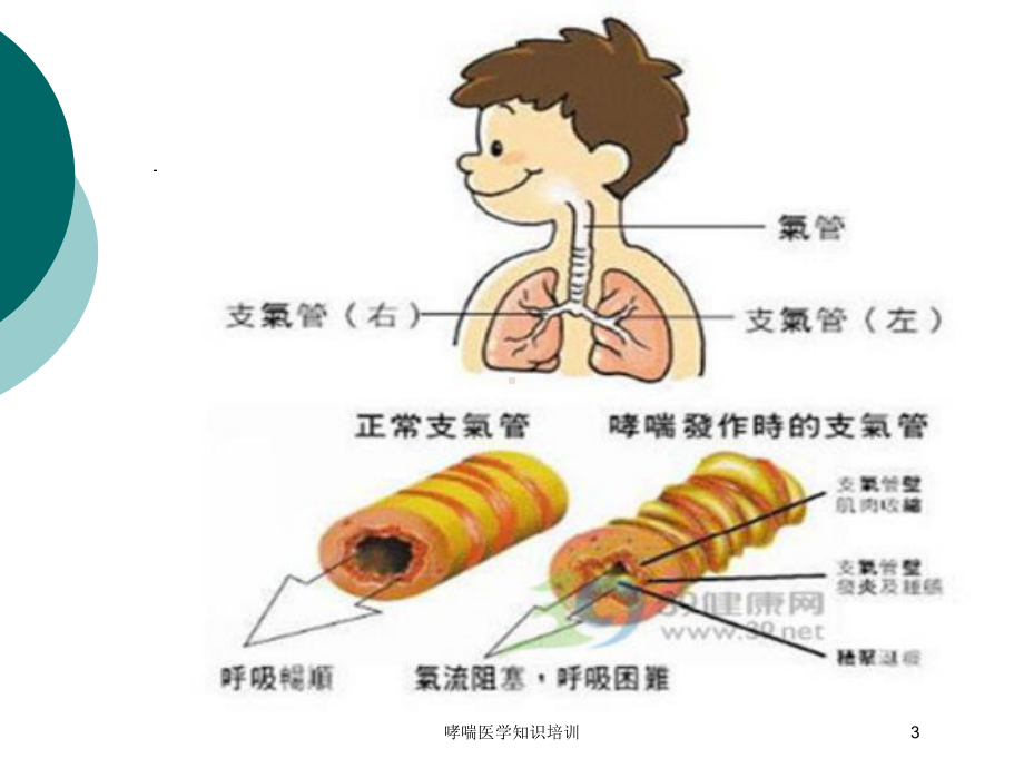 哮喘医学知识培训培训课件.ppt_第3页