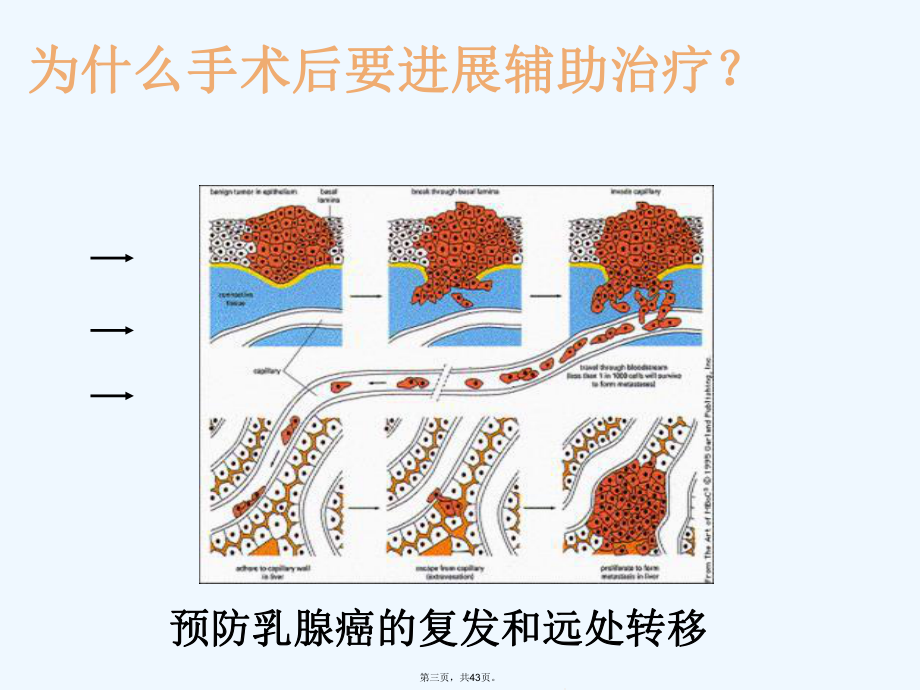 乳腺癌综合治疗课件.ppt_第3页