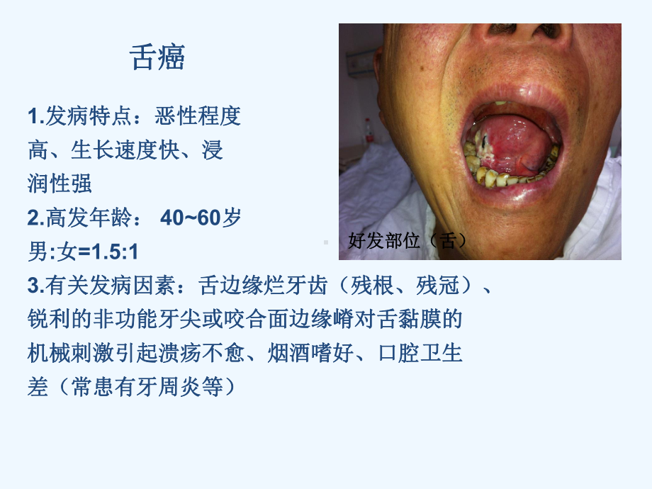 口外科舌癌护理课件.ppt_第2页