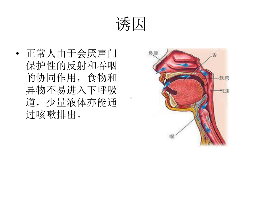 吸入性肺炎专业医学知识宣讲讲义课件.ppt_第3页