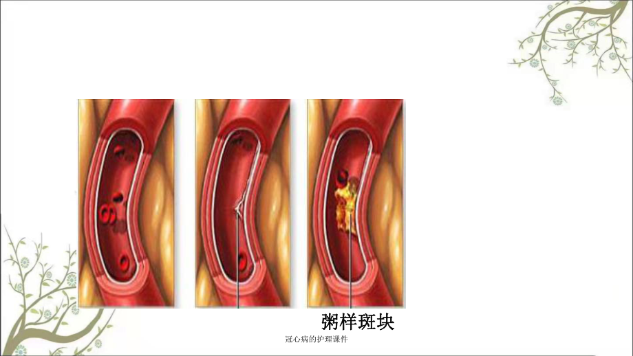 冠心病的护理课件.ppt_第3页