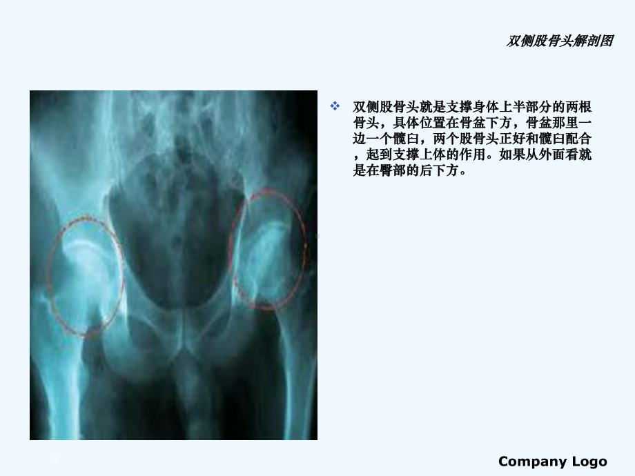 双侧股骨头坏死的护理查房课件.ppt_第3页