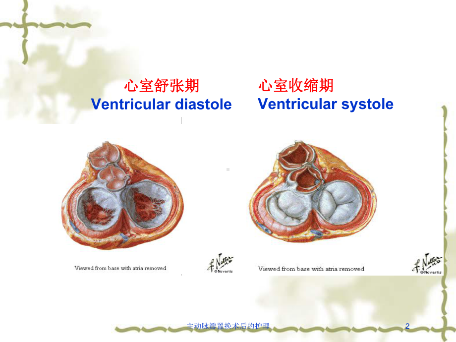 主动脉瓣置换术后的护理培训课件.ppt_第2页