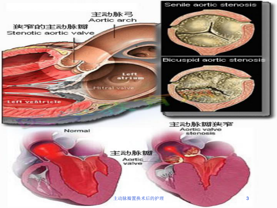 主动脉瓣置换术后的护理培训课件.ppt_第3页